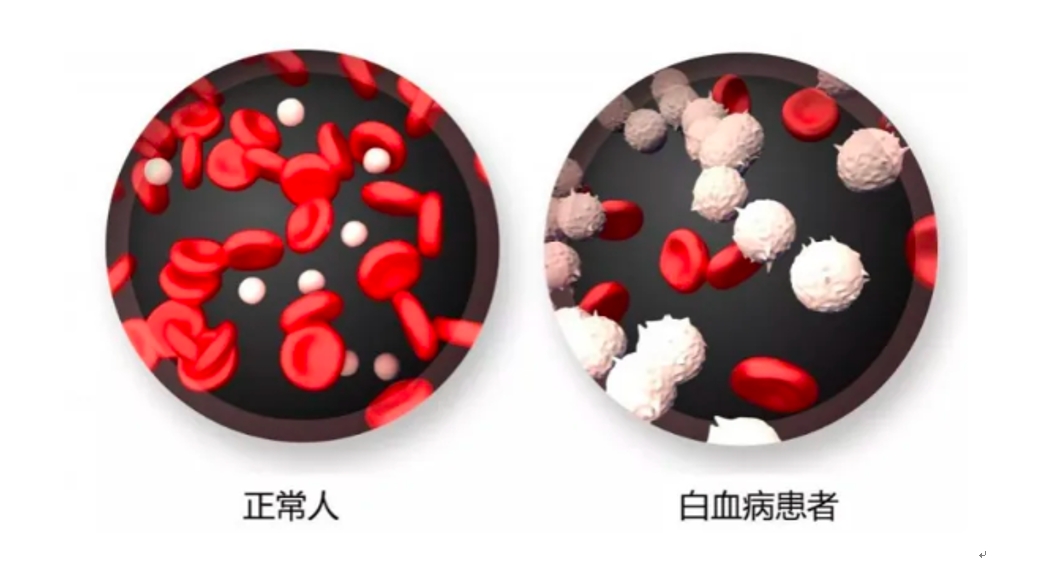 可治,可控的"慢性疾病"!带您一起了解慢性粒细胞白血病